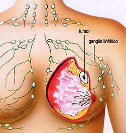 क्यान्सरका १८ लक्षणः स्तनमा परिवर्तन देखि अन्डकोष सुन्निनेसम्म